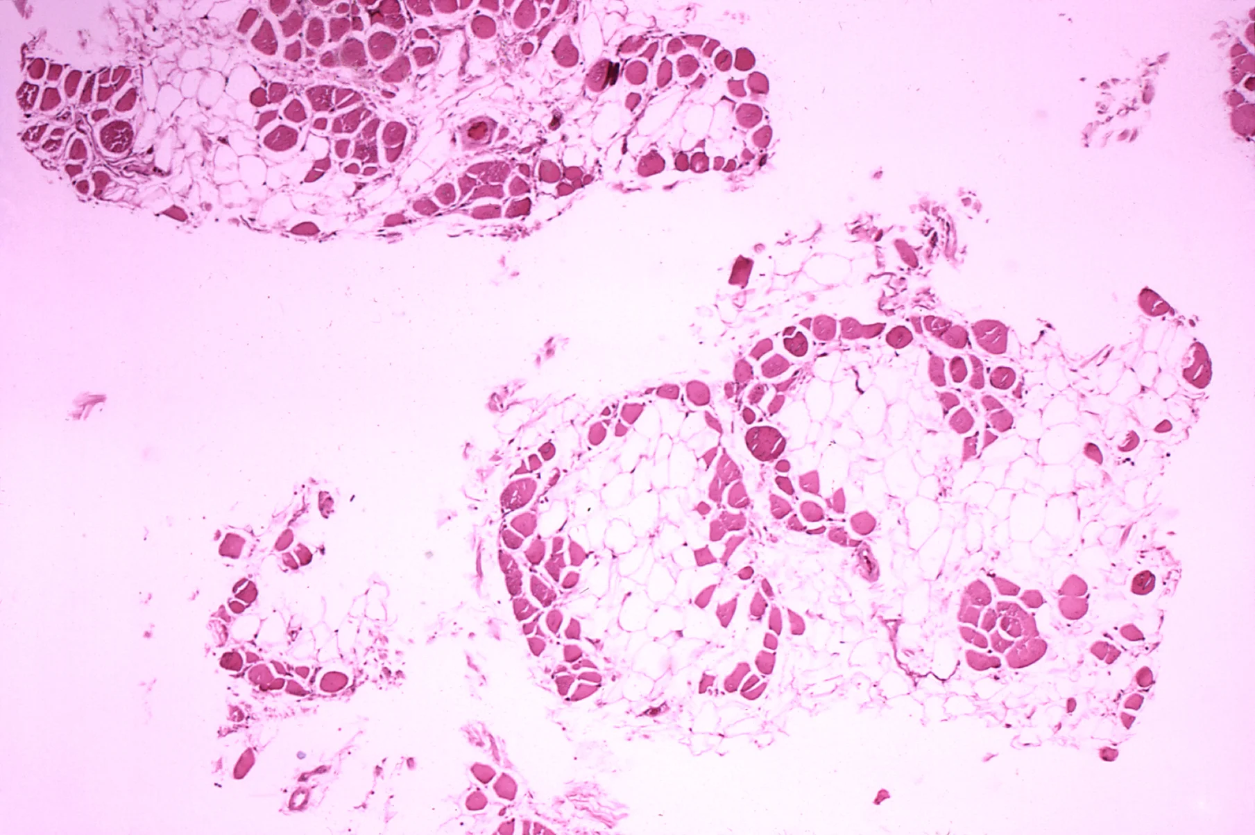 Microscopic image of the calf muscle of a person with Duchenne muscular dystrophy, in which muscle fibre cells have been replaced with fat cells. Edwin P. Ewing, Jr./Wikimedia Commons (public domain)