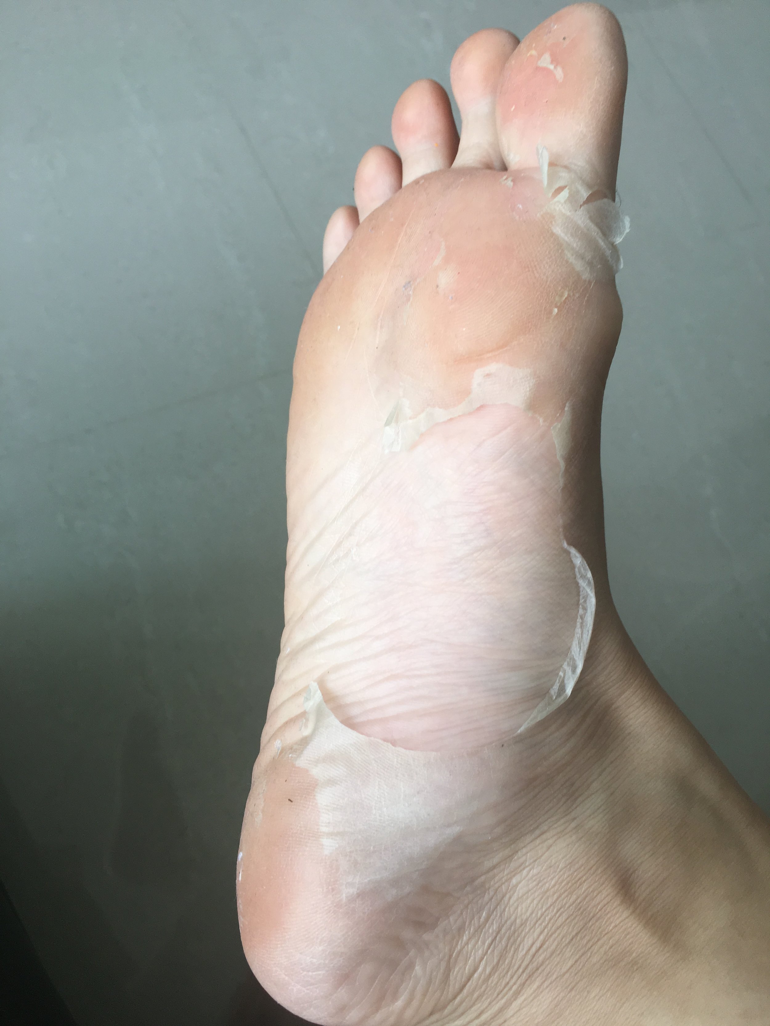 dead skin on bottom of feet peeling