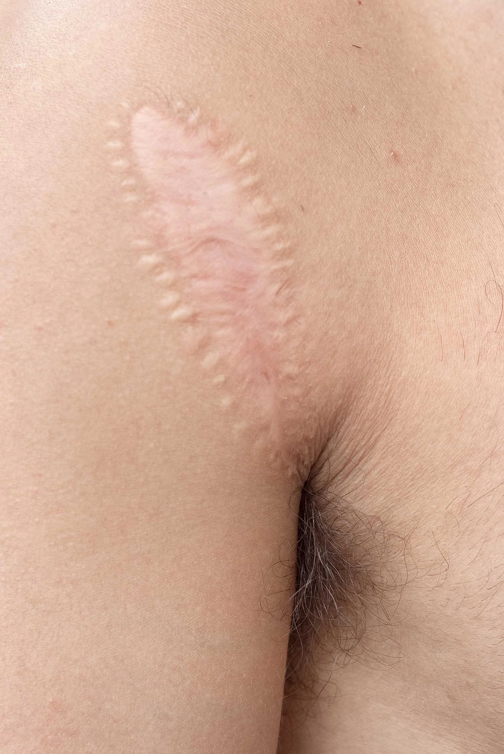 Scar