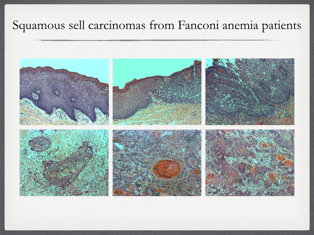 Examples of patient samples with the top left picture showing normal mucosa, the middle top picture showing transition of normal to cancerous area, and the other pictures showing tumors.