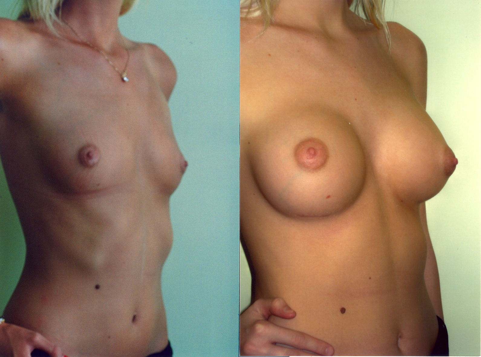 BreastAugmentation1.jpg
