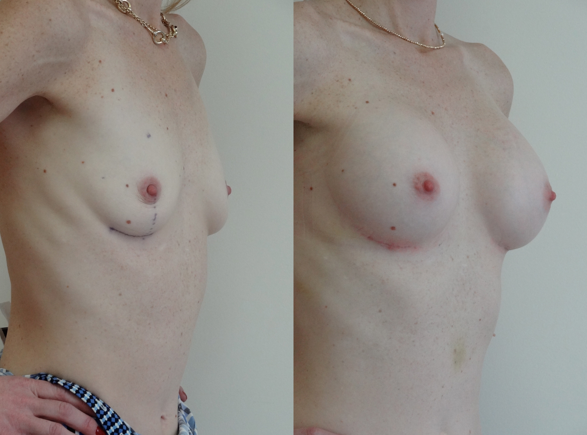 breast10.jpg