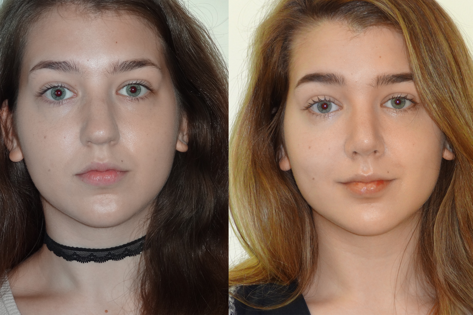 BeforeAfterKhouryNose5Front.png