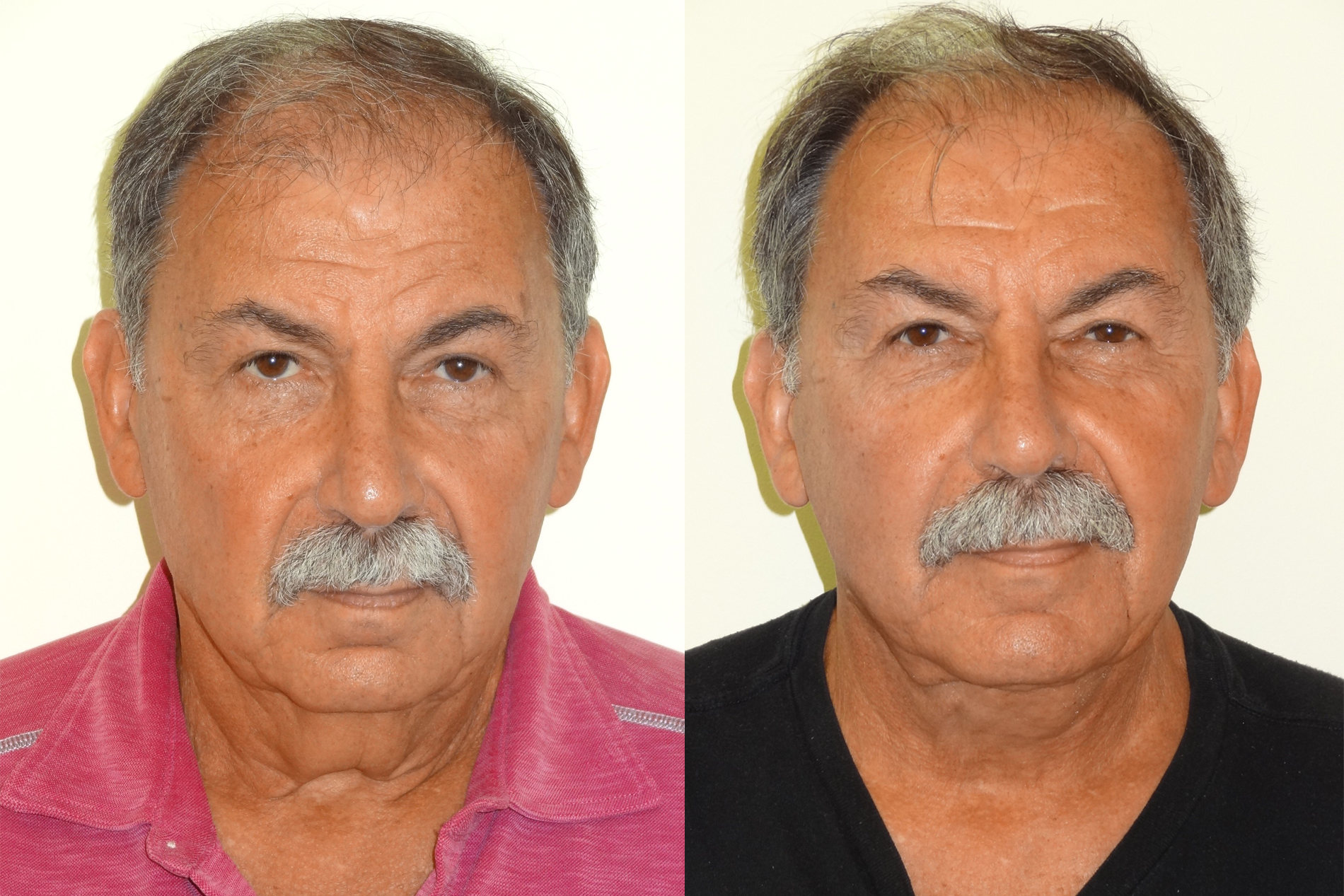 BeforeAfterKhouryFacelift5front.png