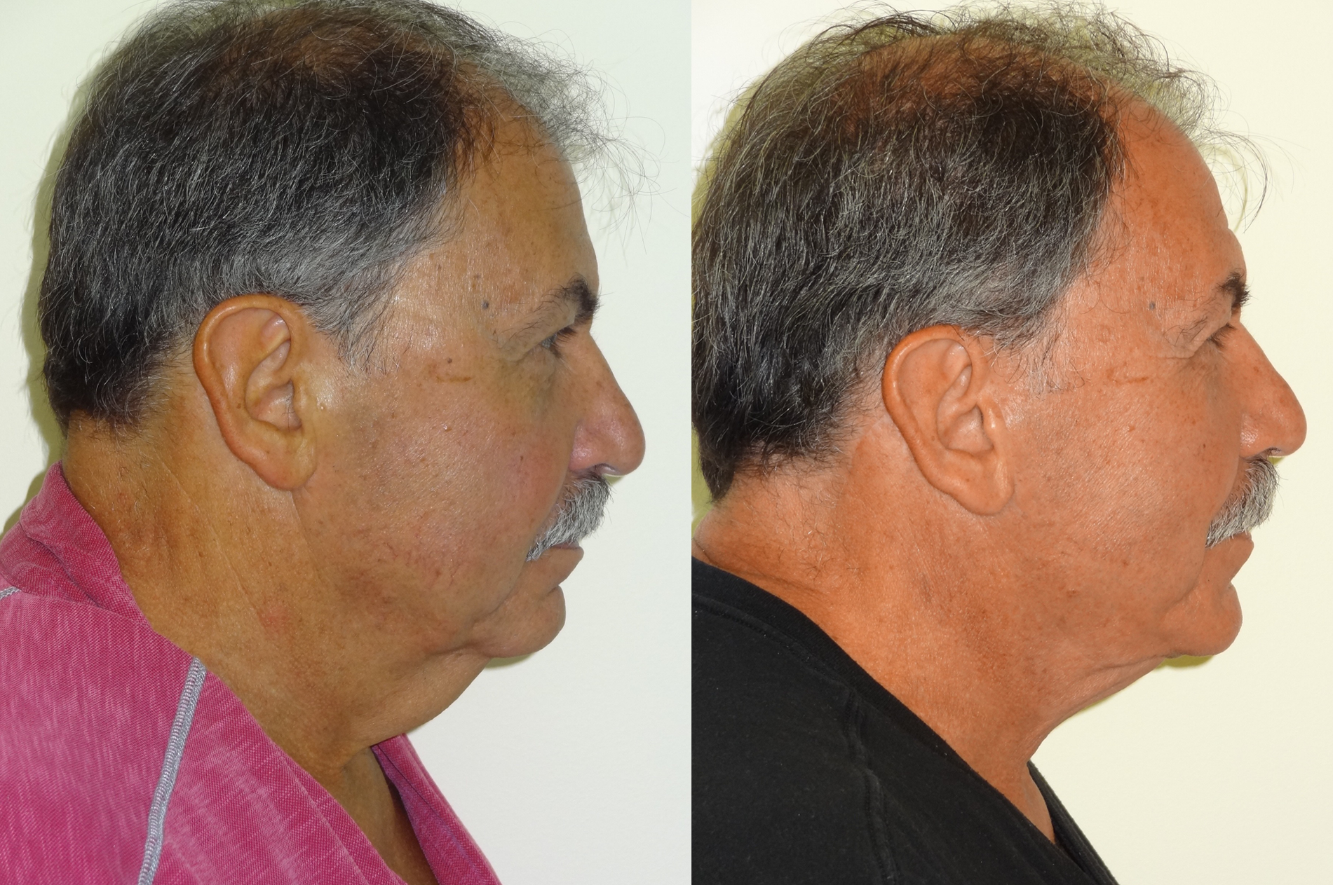 BeforeAfterKhouryFacelift5right.png