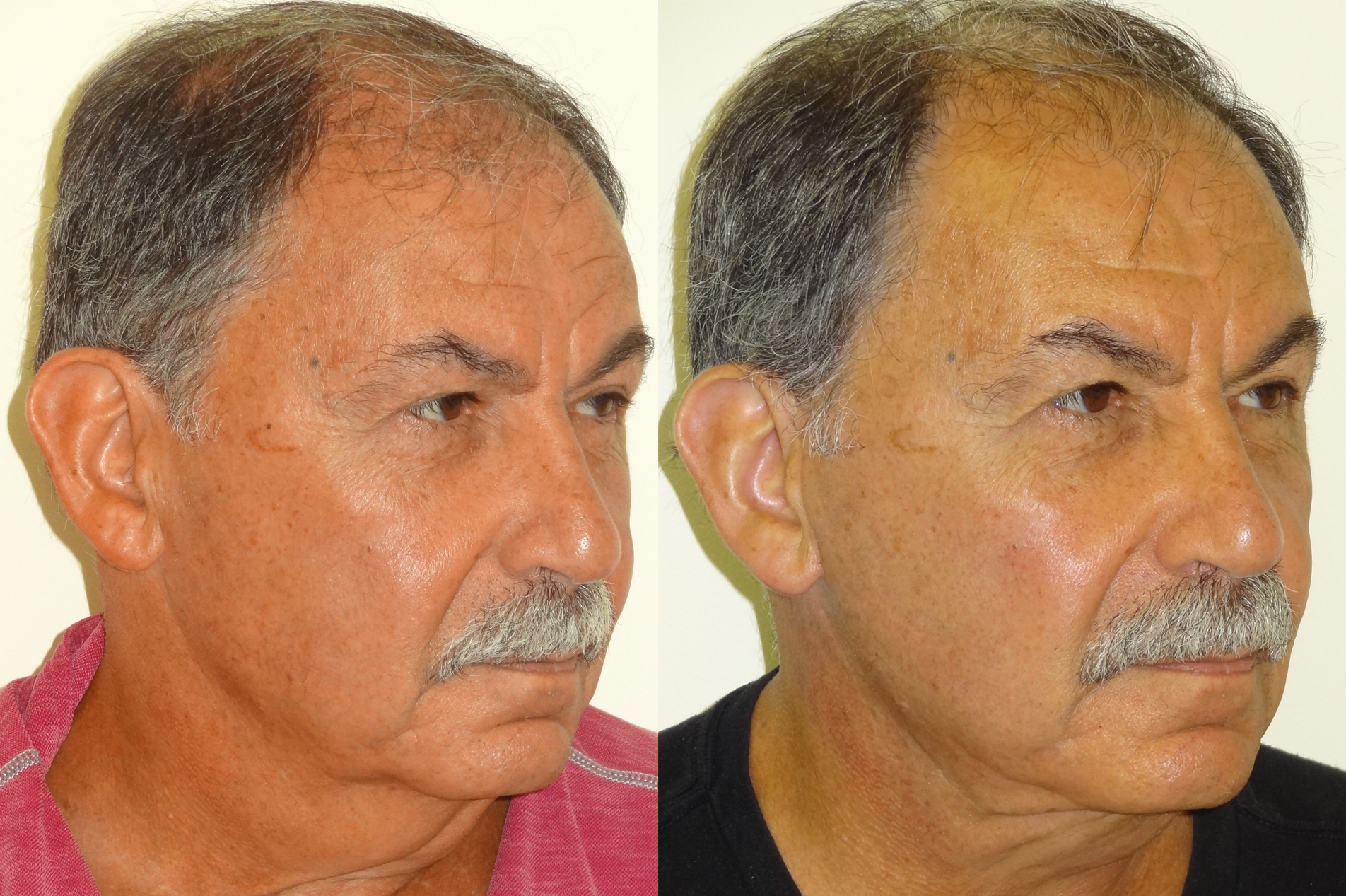 BeforeAfterKhouryFacelift5rightAngle.png