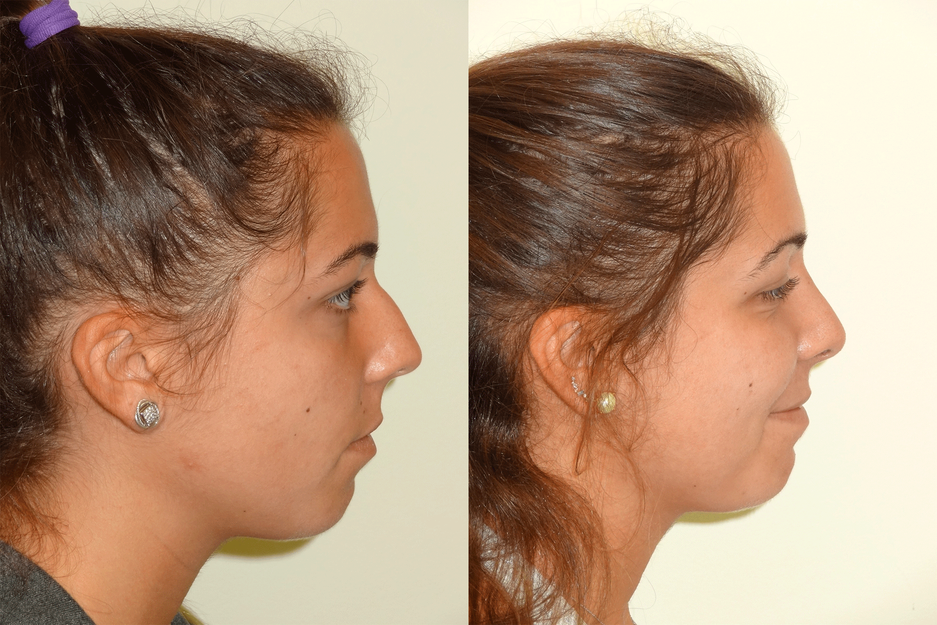 Nose6_Right.jpg