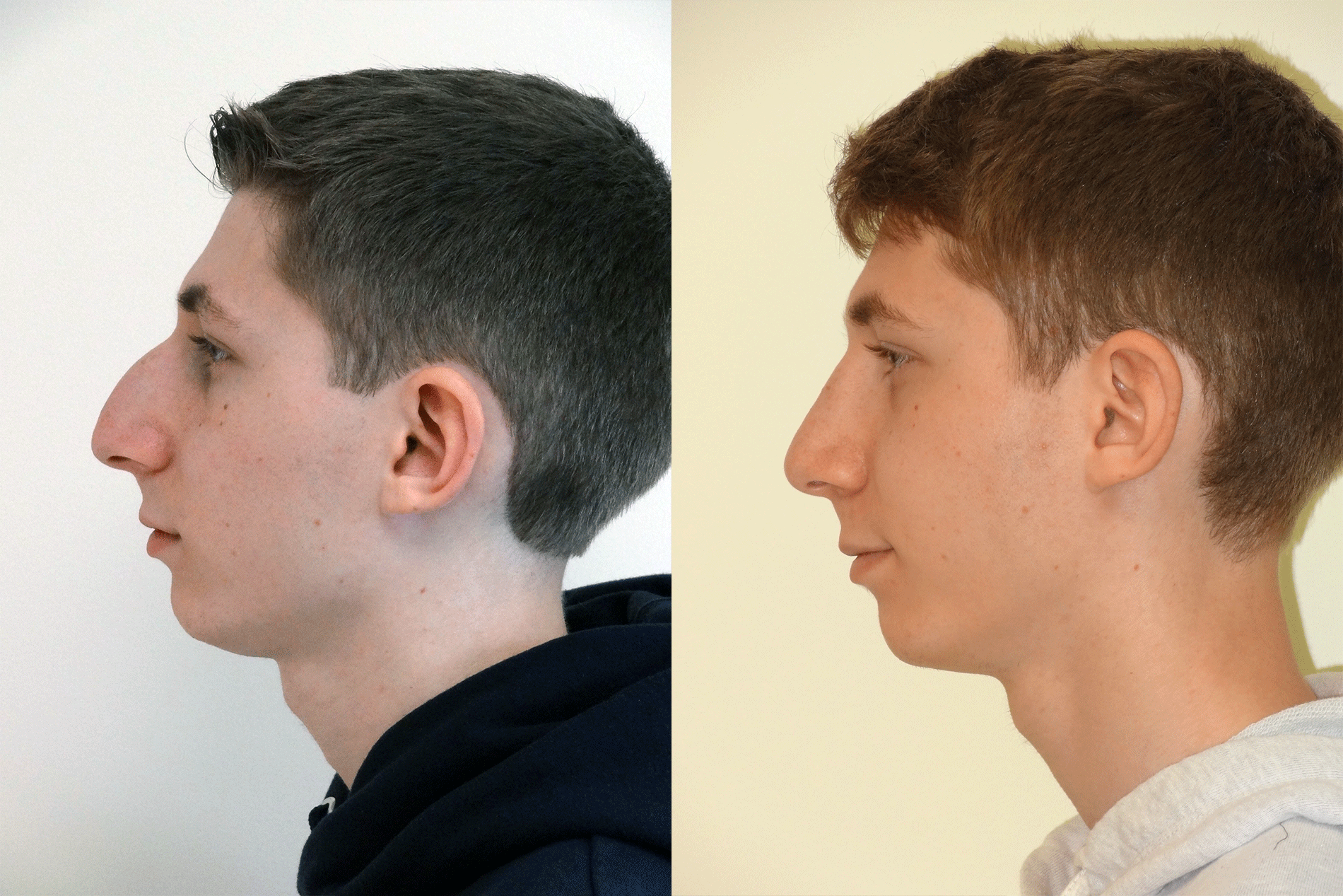 Nose7_Left.png