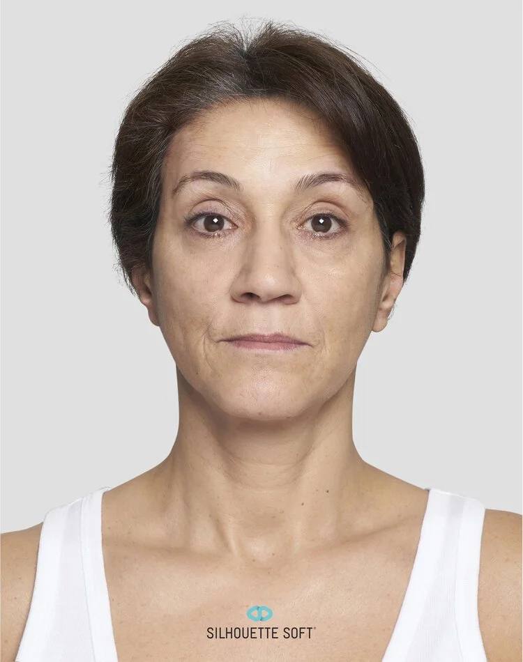 After Thread Face Lift