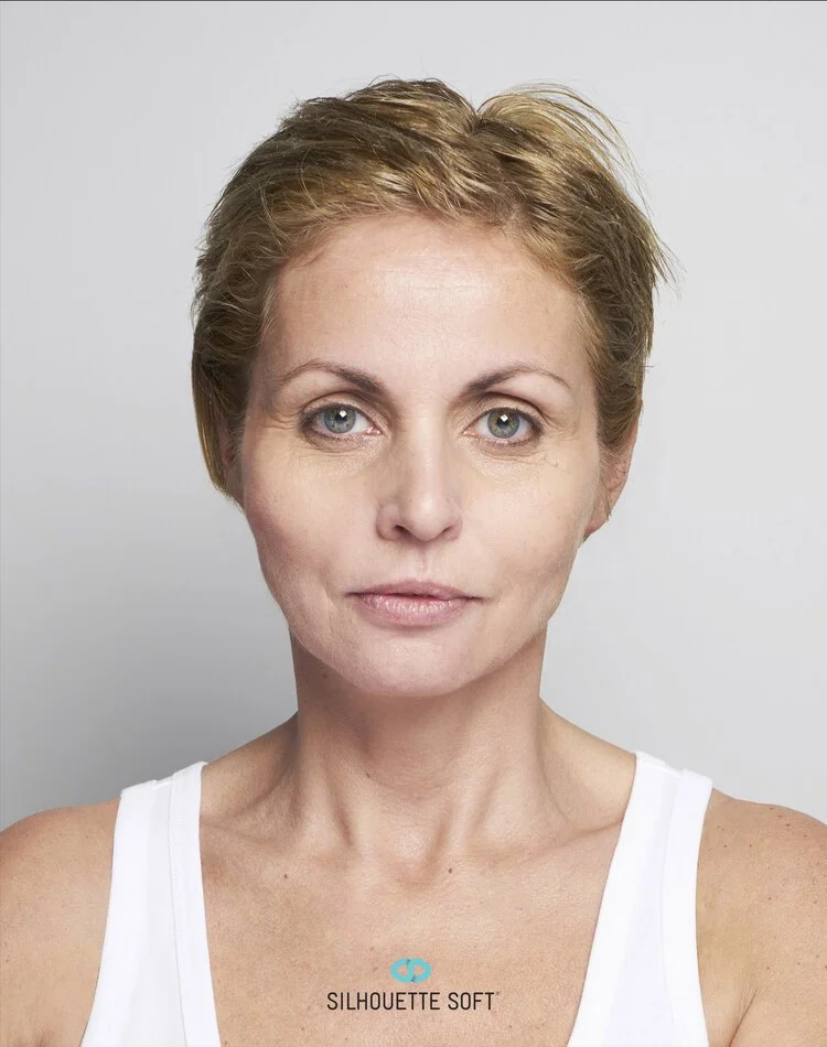 After Thread Face Lift