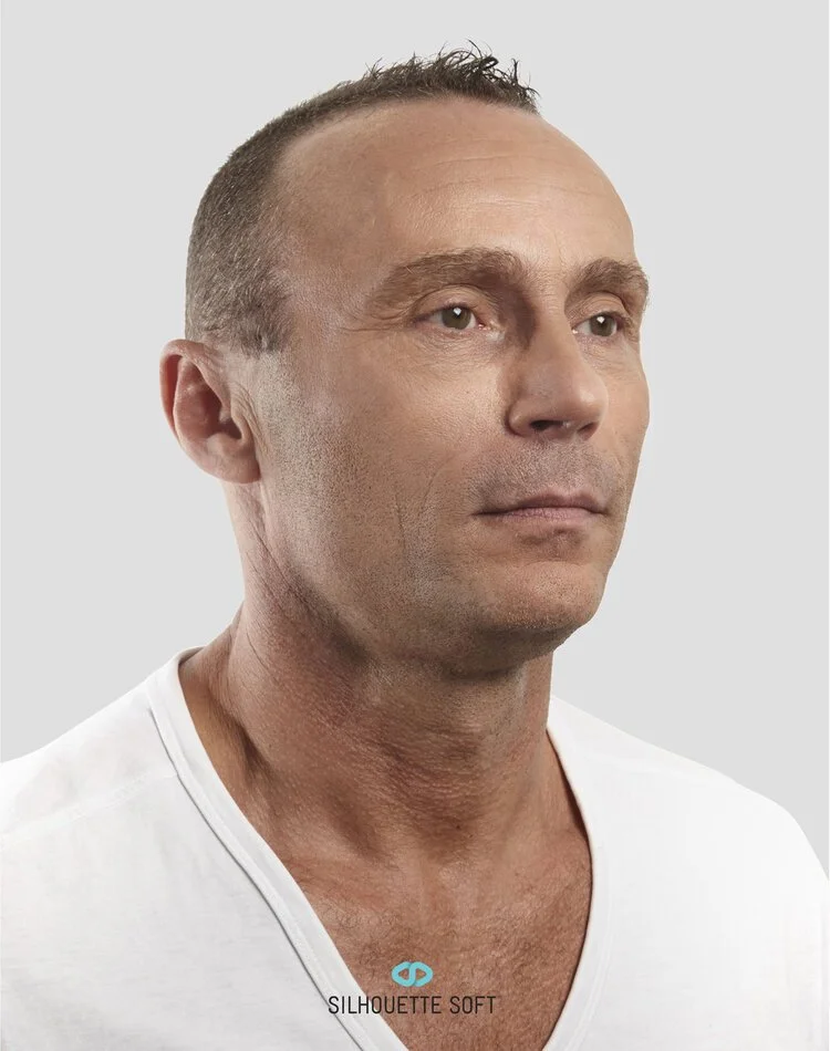 After Thread Face Lift