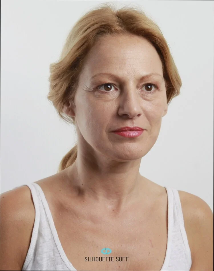 After Thread Face Lift