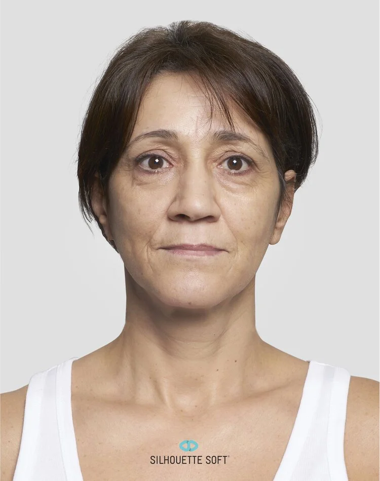 Before Thread Face Lift