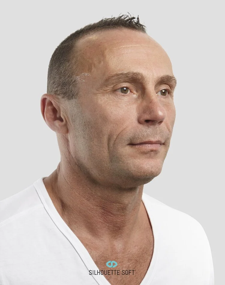 Before Thread Face Lift