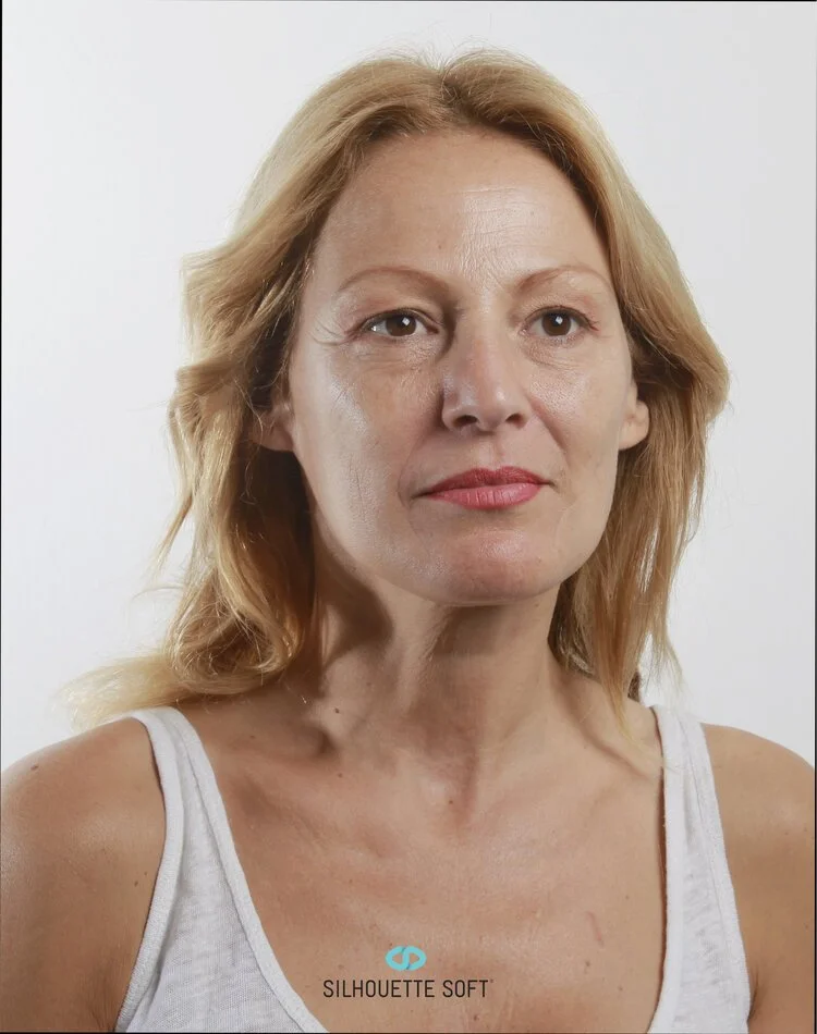 Before Thread Face Lift