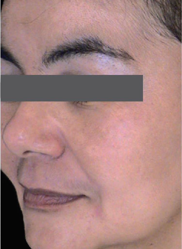 After Chemical Skin Peel