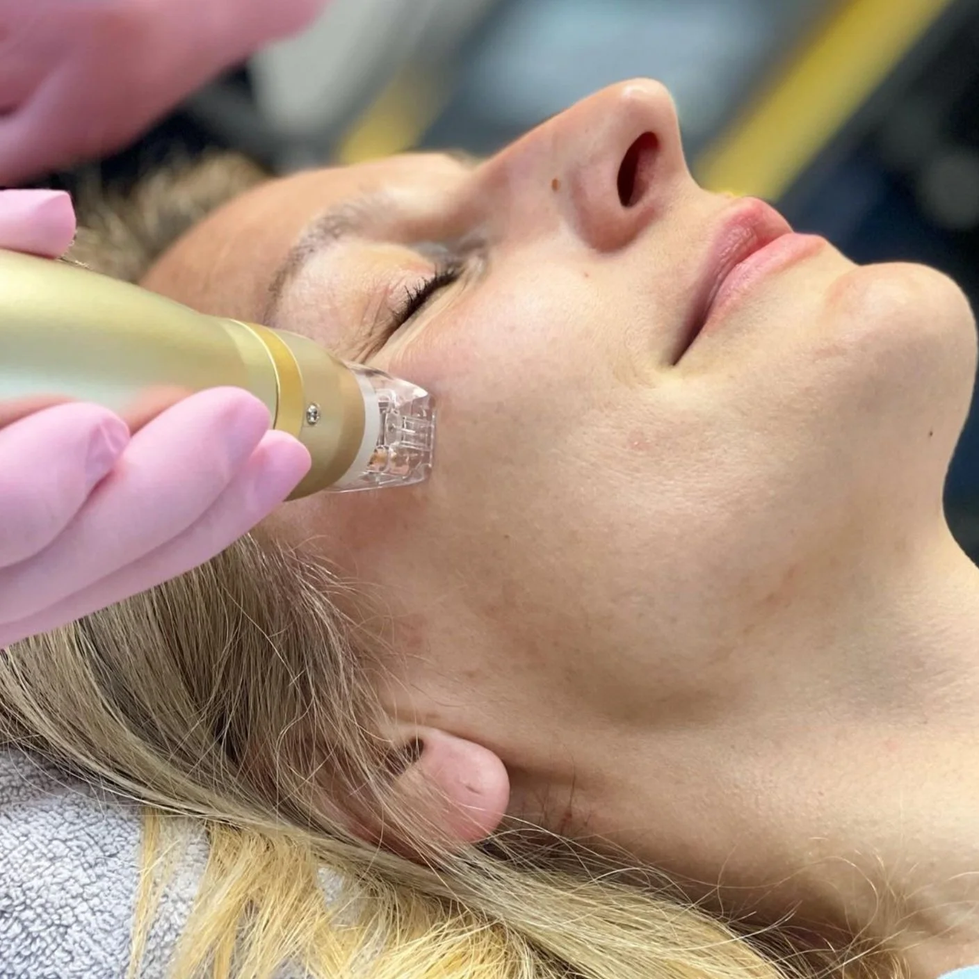 What Does Microneedling Do? 