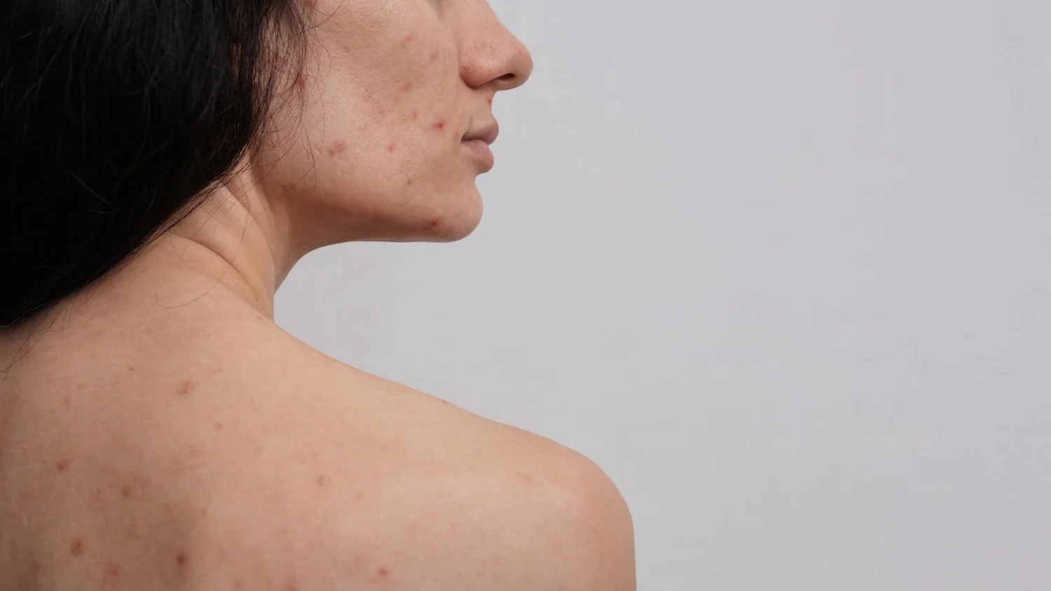 How to Get Rid of Acne Scars?: What's the Best Treatment?