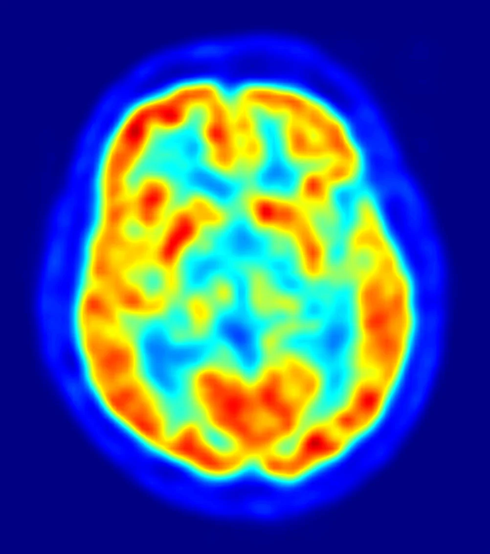 Brain Imaging Study in Cognitively Healthy, MCI and AD Subjects