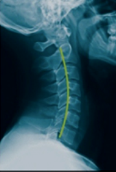 Normal Cervical Spine