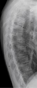 Normal Thoracic Spine 