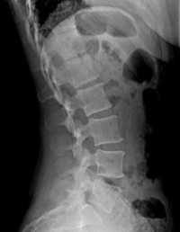 Normal Lumbar Spine