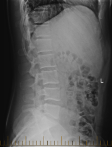 Lumbar Spine Before Treatment