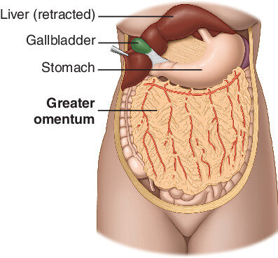 is secondary cancer in the lymph nodes terminal