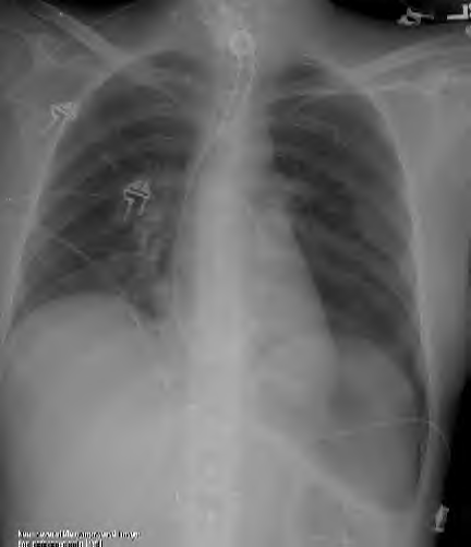  radiograph showing pneumothorax