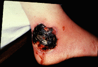 raynaudgangrene2.gif