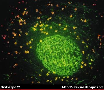 Normal lymph node