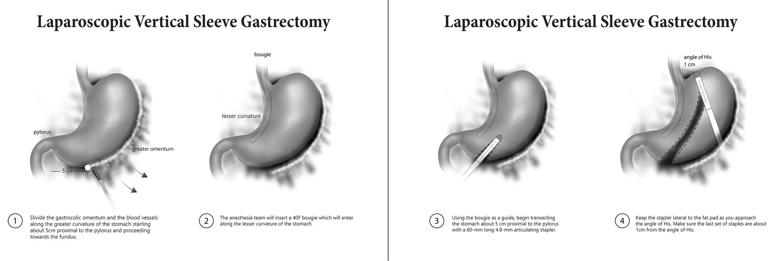 Surgical_Bariatric_VerticalSleeve.jpg