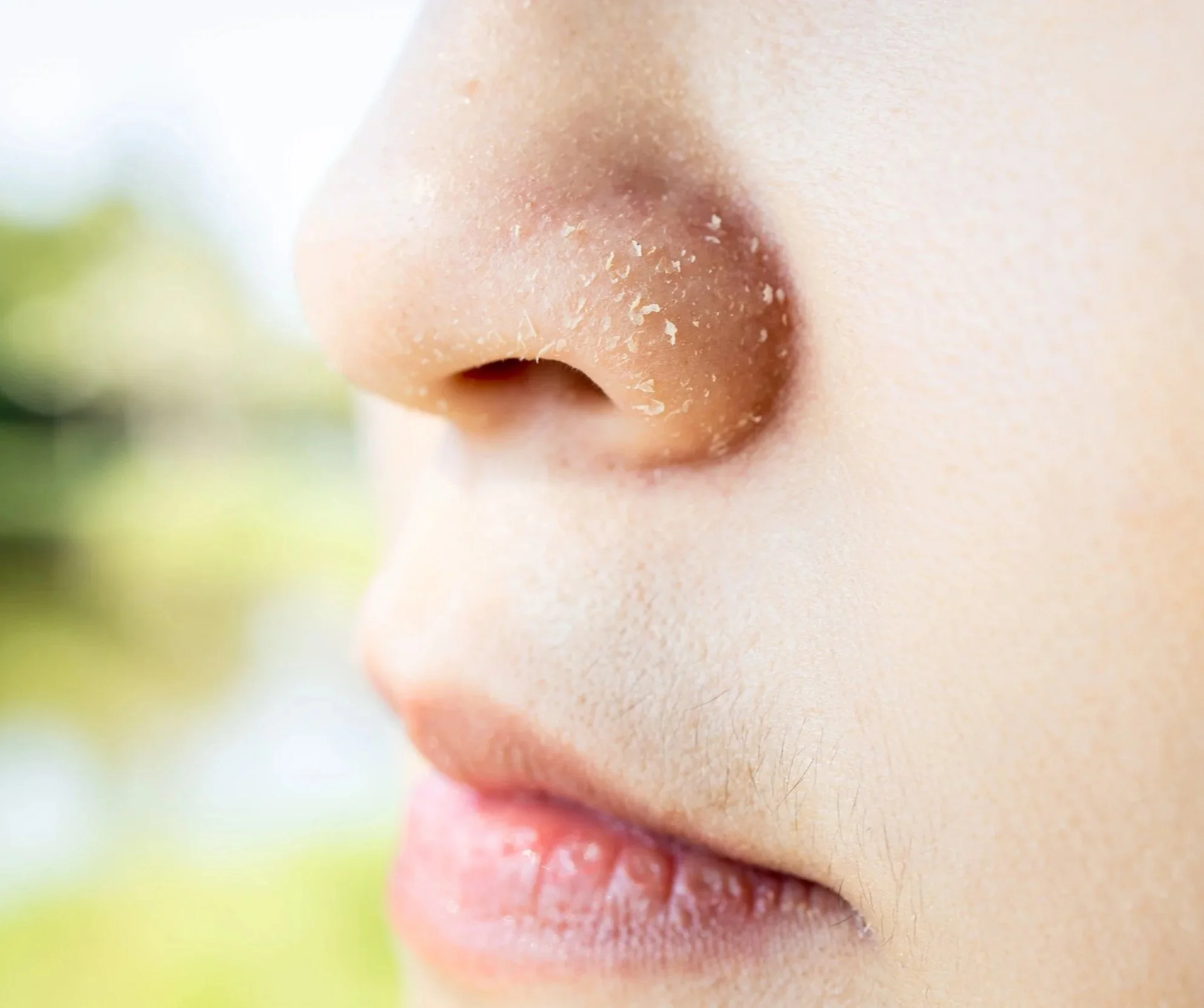Close-up of dry, flaky facial skin texture