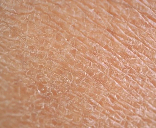 close up of rough skin texture that can occur with dryness or dehydration