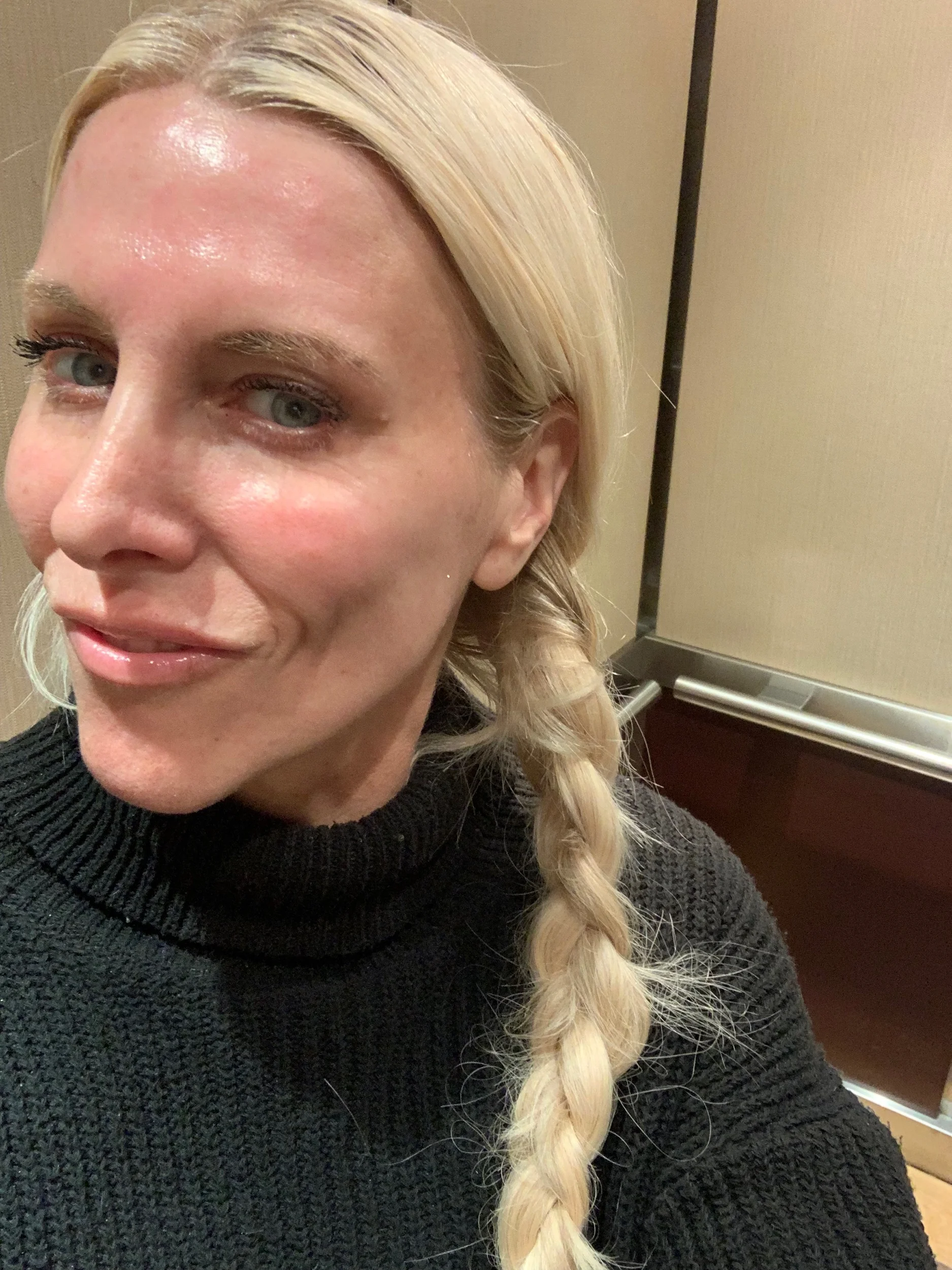 Okay, this is me in the elevator, immediately after all 3 lasers, no makeup, no filter, and only aloe-vera on my face because it feels like a slight sunburn. I was pink but only slightly and within a few hours, the hotness on my face went away!!