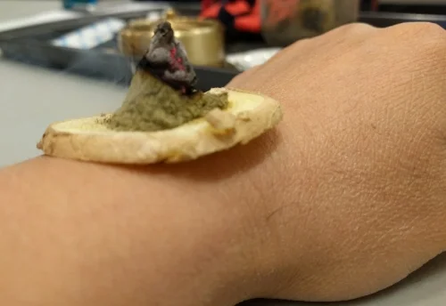 What is Moxibustion ?