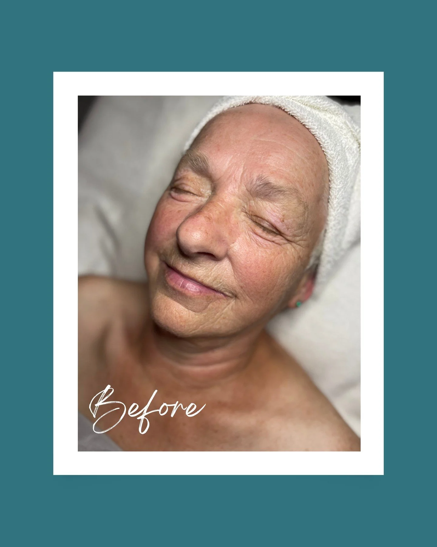This was my client&rsquo;s very first facial, and what a difference one treatment can make. ✨⁠
⁠
Years of gardening and outdoor living had left her skin weathered and dehydrated, so we focused on replenishing moisture and strengthening her barrier wi