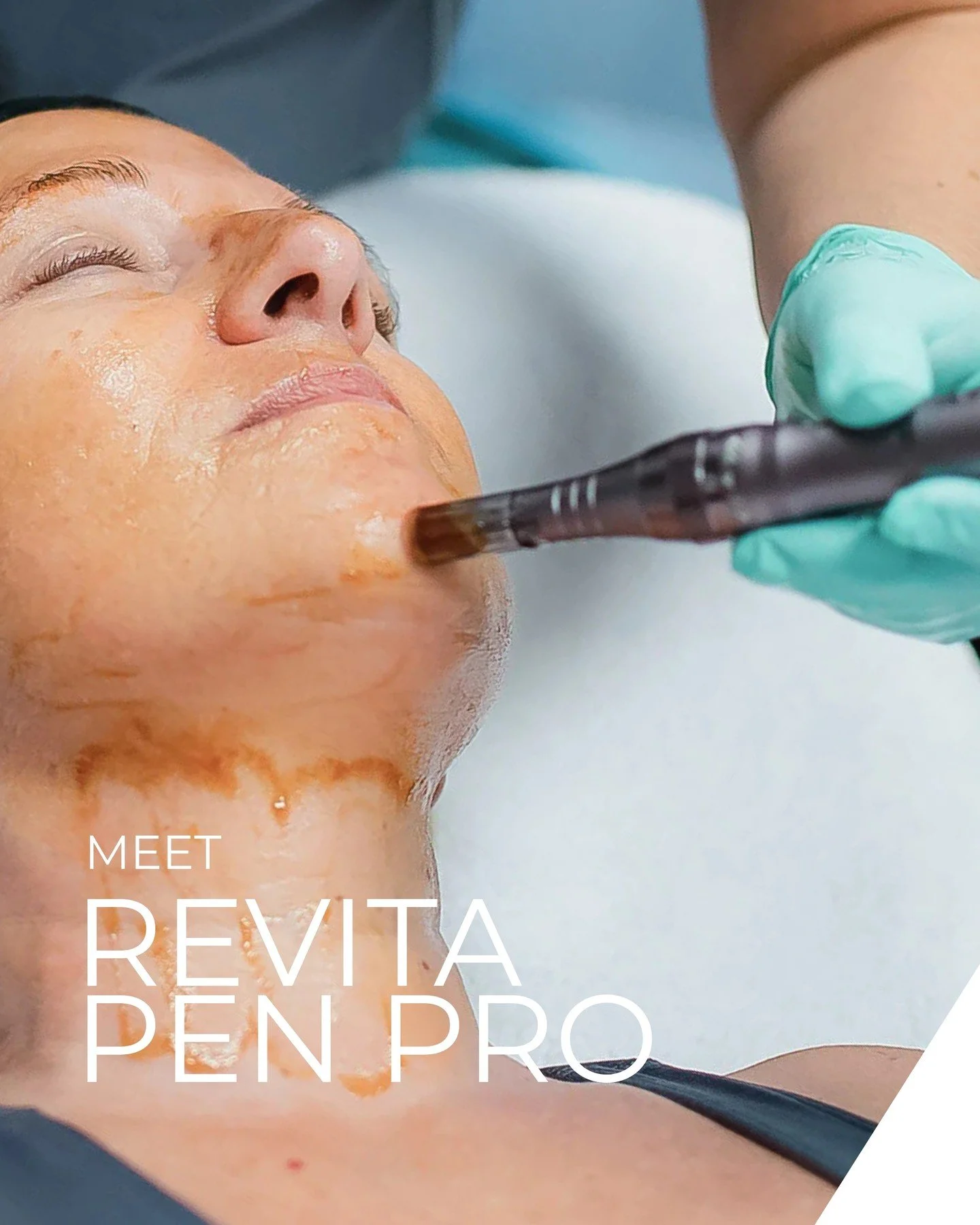 ✨ Proof that consistent, targeted treatments make a difference. ⁠
⁠
This client came in for her first visit after not having a facial in a long time.⁠
⁠
Her goals were simple:⁠
⁠
✅ A healthy, radiant glow⁠
✅ Softer-looking fine lines⁠
⁠
We focused on