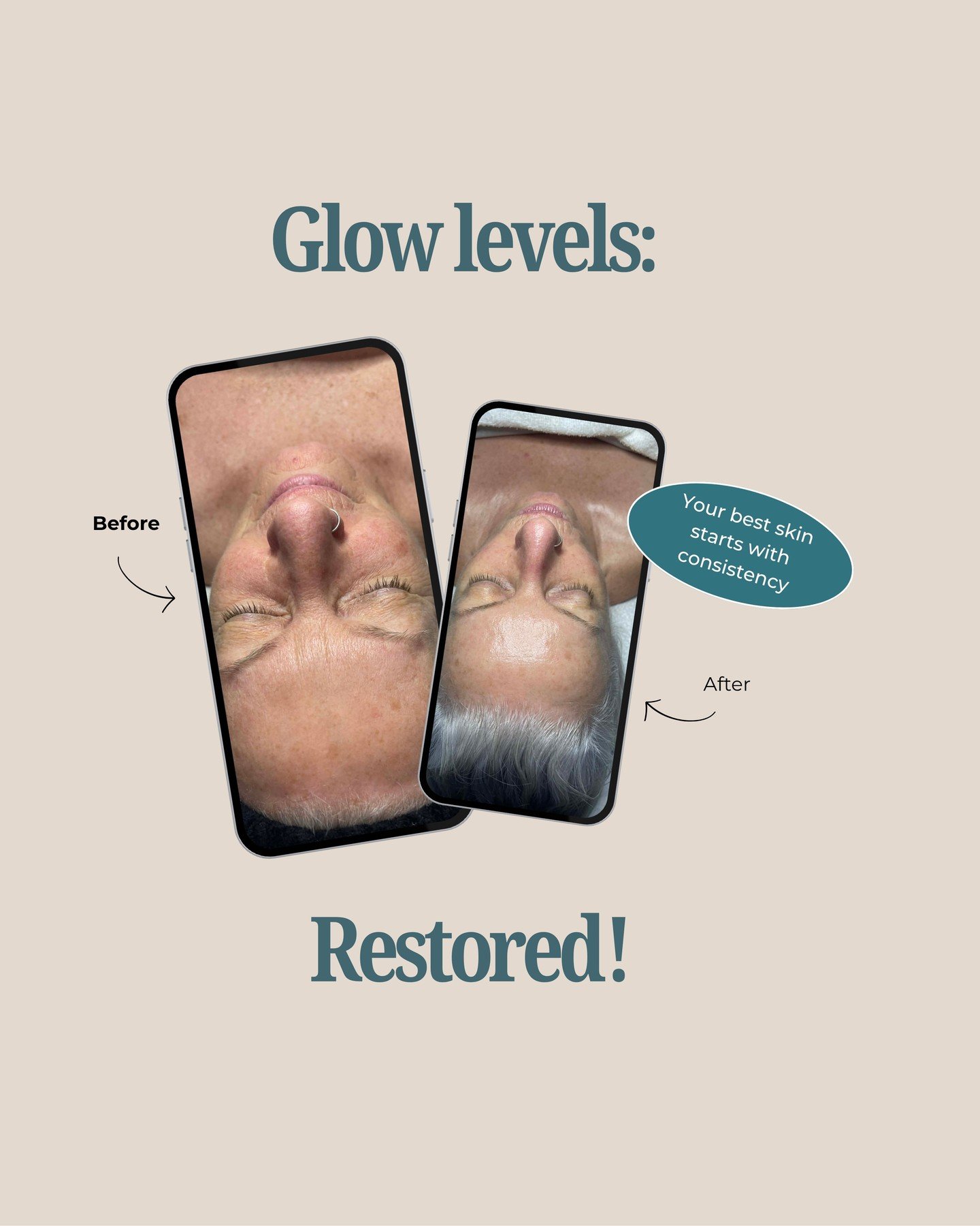 ✨ This is what consistency looks like!⁠
⁠
Main concerns: ⁠
⁠
✔ Fine lines + wrinkles⁠
✔ Dullness⁠
✔ Uneven skin tone⁠
⁠
🔍 We started with a New Client Facial, full skin analysis, and a customized treatment plan tailored to her skin goals.⁠
⁠
💉 In s