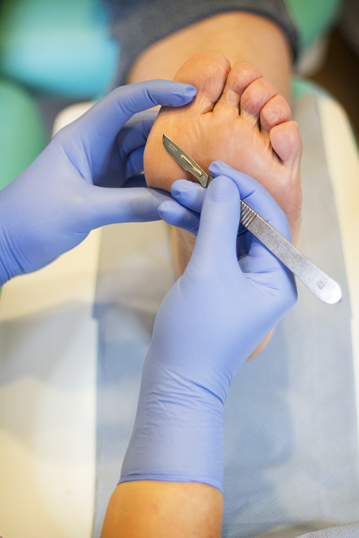 scalpel callous.jpeg