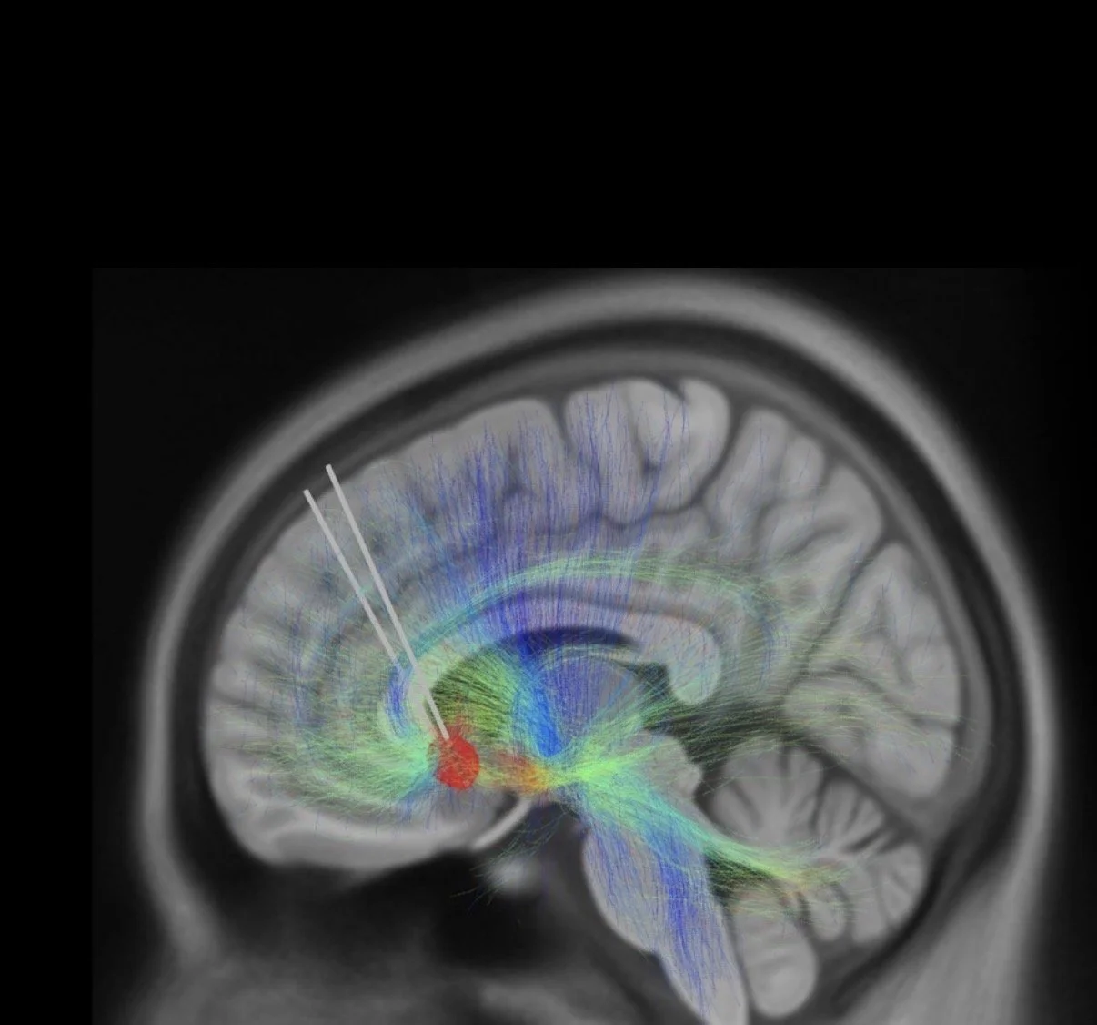 Understanding the Right Time for Deep Brain Stimulation