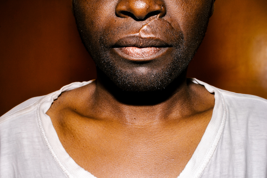   Soon after arriving in Kenya, S. was attacked by seven men with machetes. Here, he poses for a portrait in the apartment he shared with his boyfriend (though he has since moved), with one scar from the attack clearly visible. Others on his face and