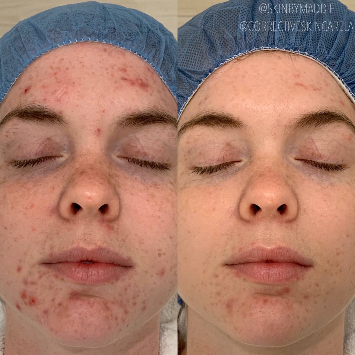 how to deal with adult acne, corrective skincare la