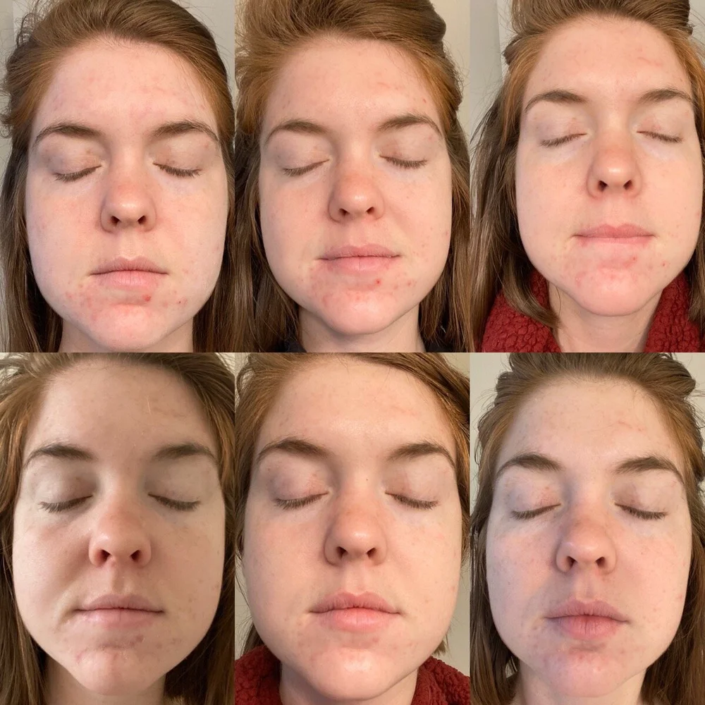 Benefits Of A Chemical Peel And What To Expect Lments Of Style Fashion Lifestyle Blog