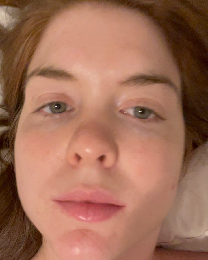 Was feeling my skin last night and just had to share my acne journey. No filter // only things on my skin in the video / next photo are @primallypure baby balm and @mybkr Paris balm.
.
Adult acne is one of the most difficult things I have battled. Fr