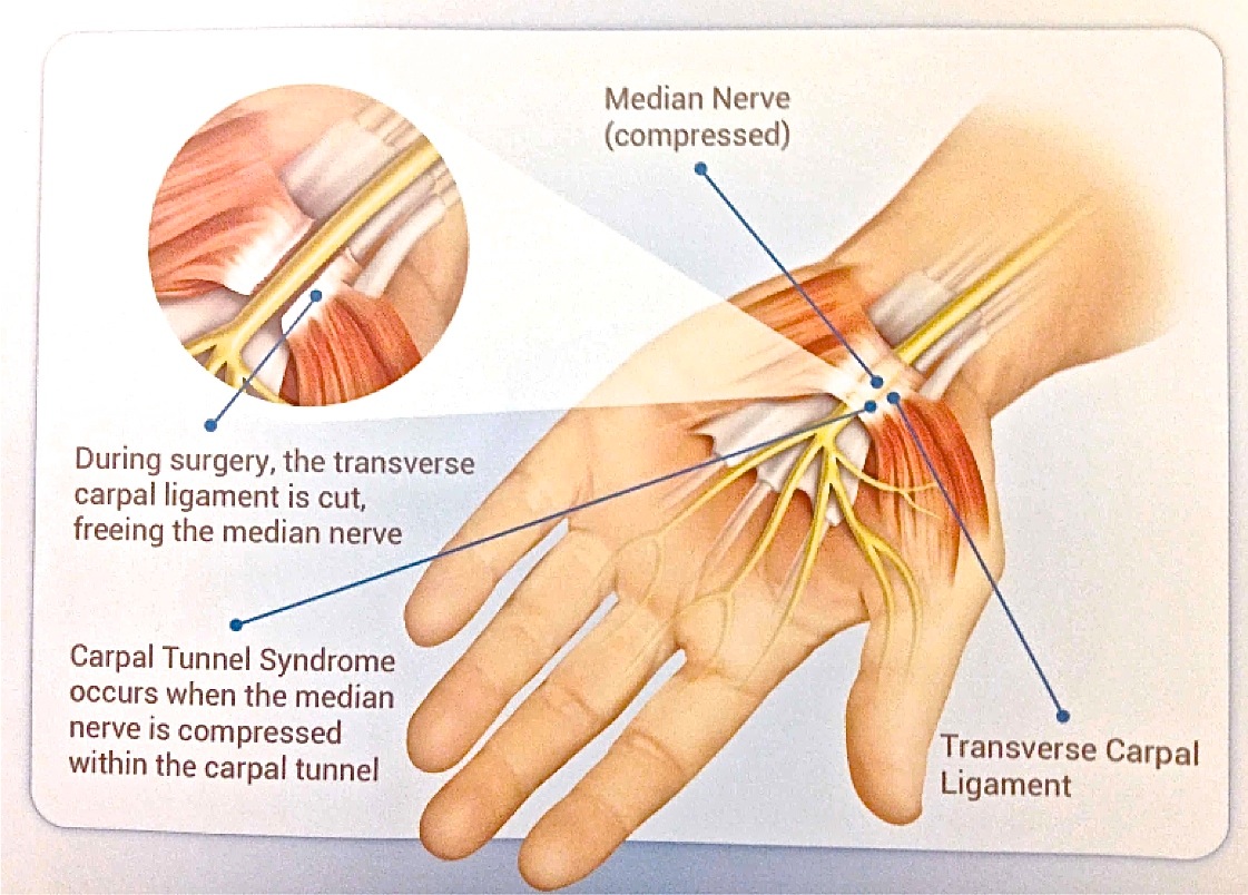 Carpal tunnel release Information