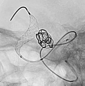 Rapid Medical’s Comaneci Adjustable Remodeling Mesh Exceeds 500 Successful Aneurysm Treatments