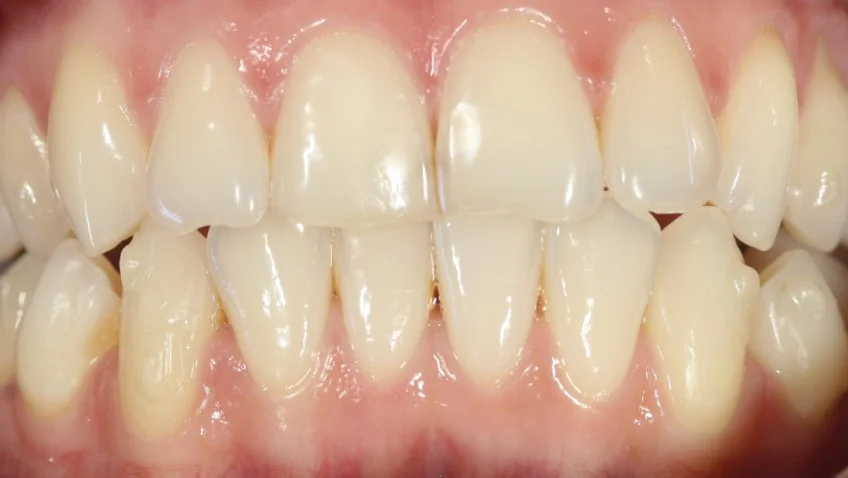 My Invisalign Journey