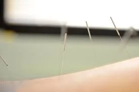 acupuncture prospect