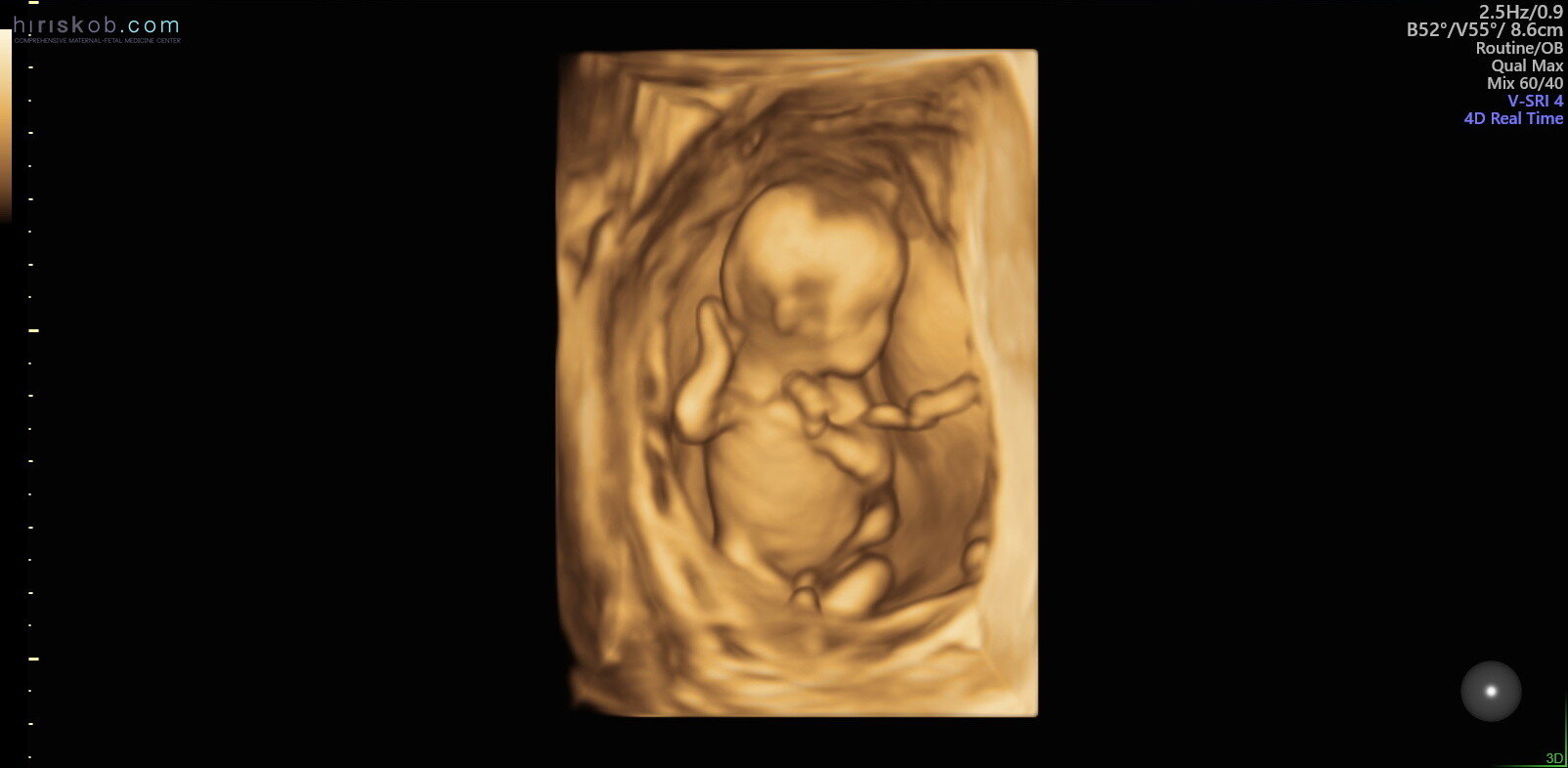 At weeks ultrasound gender 13 Week 13